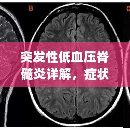 突发性低血压脊髓炎详解，症状、诊断与有效治疗方法