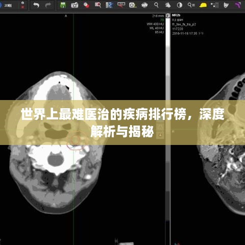 世界上最难医治的疾病排行榜，深度解析与揭秘